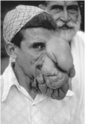 Elephantiasis Sonora